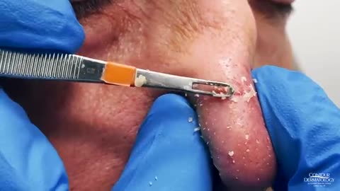 Nose Blackheads Extracted | CONTOUR DERMATOLOGY