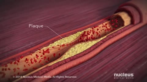 What is a Coronary Angioplasty