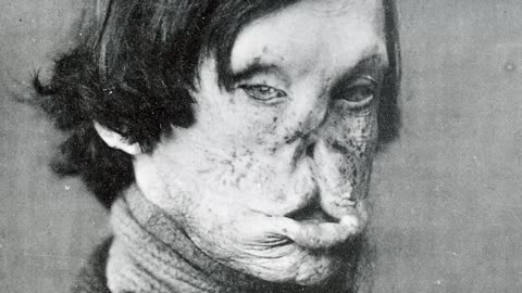 The horrifying history of leprosy| disturbing history #scary