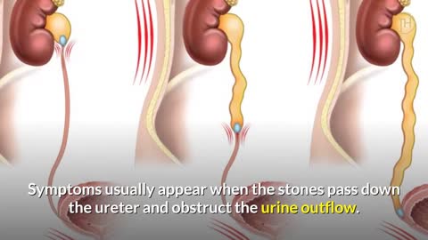 Symptoms Of Kidney Stones _What Are The Most Common Signs & Symptoms Of Kidney Stone Disease
