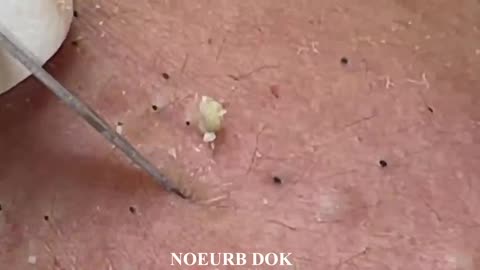 Popping Tons of Blackheads Part 1