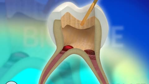 Dental restoration