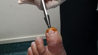Removing the Pin Holding Toe Together After Chainsaw Accident