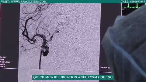 MCA Bifurcation Aneurysm Coiling Masterclass! 🧠*