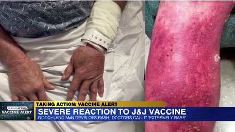 Man’s Skin ‘Peeled Off’ 4 Days After Receiving The Johnson & Johnson COVID-19 Vaccine
