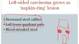 Colorectal Carcinoma