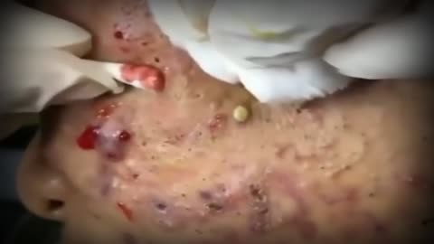 Giants Deep Blackheads, Whiteheads, Big Pimples, Hidden Acne Removal - Best Popping Videos #000022