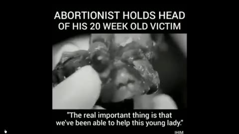 Abortionist holds up head of 20 Weeks Old pre-born victim of Infanticide