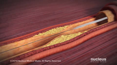 Coronary Artery Angioplasty ( Radial Access)