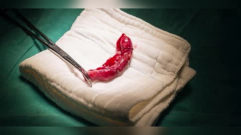 Fact’s About APPENDIX And It's Pain You Must Know