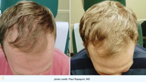 PRP for Hair Loss | PRP Therapy