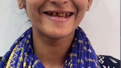 Full Mouth Rehabilitation Treatment in Navi Mumbai