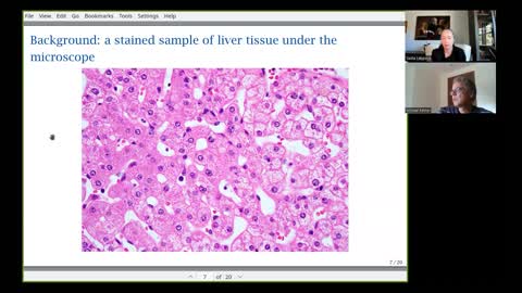 Autopsy findings from Covid-19 Vaccine victims - fatal damage from vaccine induced spike protein