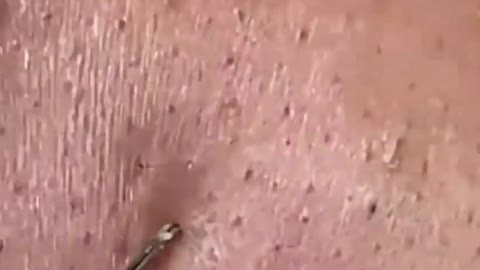 Giants Deep Blackheads, Whiteheads, Big Pimples, Hidden Acne Removal - Best Popping Videos #000008