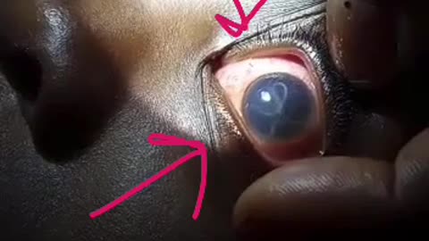 Parasite in the eye