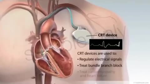 Cardiac resynchronization therapy