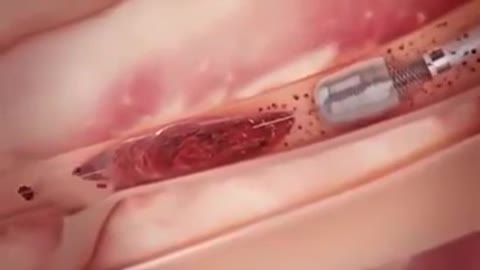 Newest Technology Heart Stent video (Angioplasty) New Medical Line Video Heart Attack reasons
