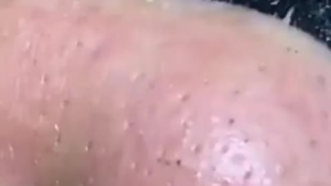 Nose Full Of Blackheads. Blackheads Removal With Pore Strips.