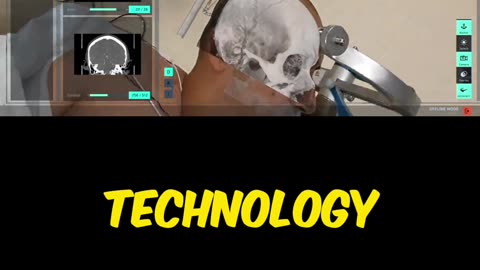 Apple Vision Pro in Surgery: A Technological Breakthrough! #applevisionpro