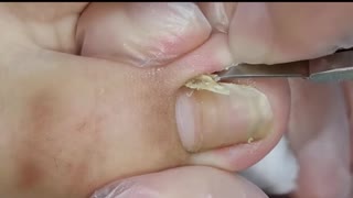 SATISFYING Toenail Ingrown Removal!