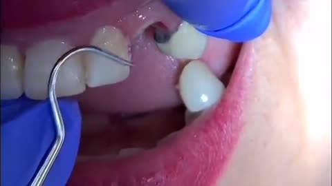 Extracting a broken tooth forcibly