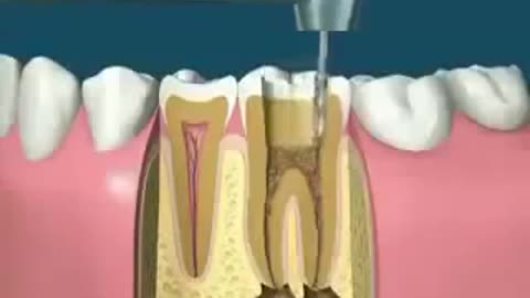 🛑How to wear molar tooth Comment porter la molaire