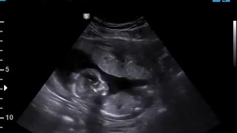 Baby hiccuping in the womb! 😇