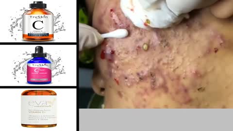 Blackheads Removal & Pimple Popping Videos 2021