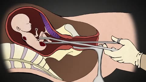 Abortion Process ▪️ 1-minute Explanation & Description 👀