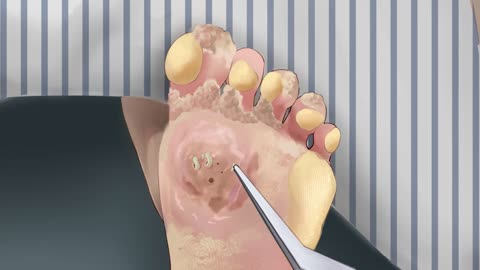 ASMR Remove thick dead skin cells and calluses Plantar Warts, Corn animation