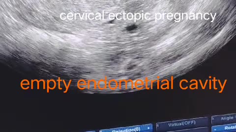 Cervical ectopic pregnancy