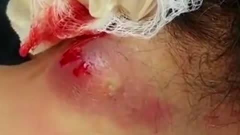 Giants Deep Blackheads, Whiteheads, Big Pimples, Hidden Acne Removal - Best Popping Videos #000034