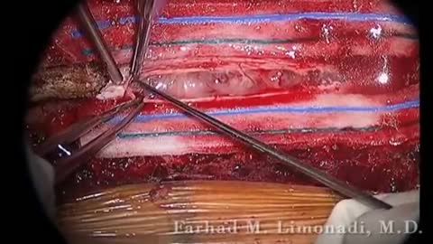 Spine Tumor Removal of Thoracic Schwannoma: Actual footage of Spine Surgery