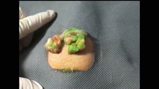 Incredible cyst extraction