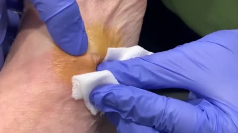 Giants Deep Blackheads, Whiteheads, Big Pimples, Hidden Acne Removal - Best Popping Videos #000027