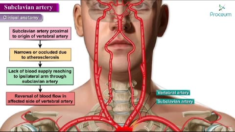 Subclavian Artery clinical anatomy