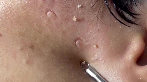 SATISFYING VIDEO!!! BLACKHEAD REMOVAL OF ACNE FACE.