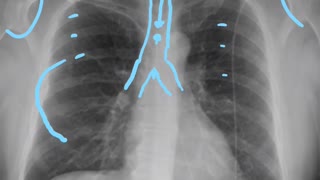 CXR Anatomy