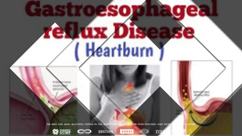 Heartburn No More Review | “Heartburn No More” Helps Get Rid Of Acid Reflux After Two Months