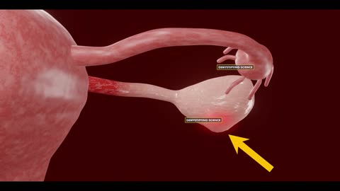 Ovarian Torsion - Twist In Female Ovaries