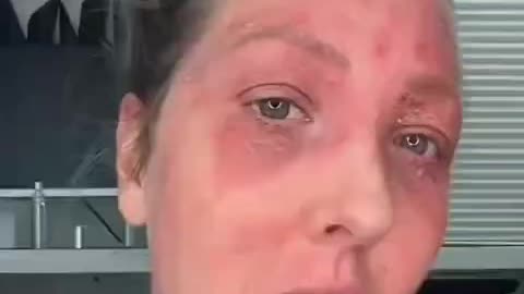 Young woman breaks down crying over her Vaccine injuries… This is heartbreaking…