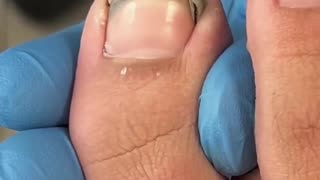 Dirty toenail trimming
