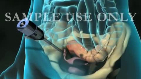 Diagnostic pelvie laparoscopy Exam