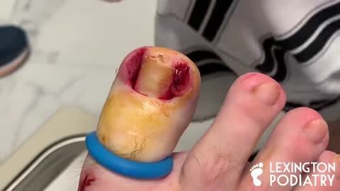 BLOODY INGROWN TOENAIL