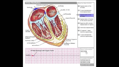 Dr Stanley's ECGcourse.com | Atrial Fibrillation Tutorial