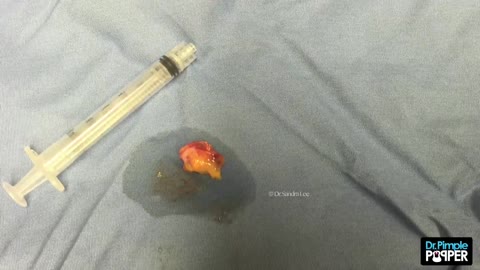 Excision of a bump, was unsure of the diagnosis during surgery