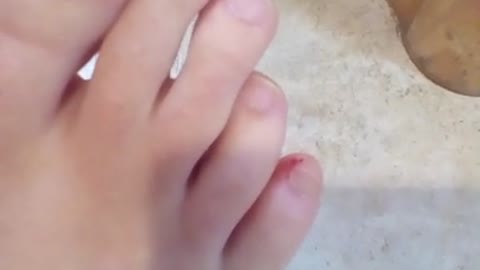 Broken Toe
