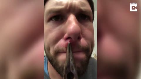 Man Removes Unknown Object Stuck In His Top Lip