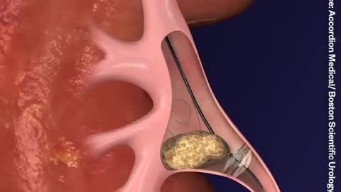 This is how doctors 👨‍⚕️ remove kidney stones