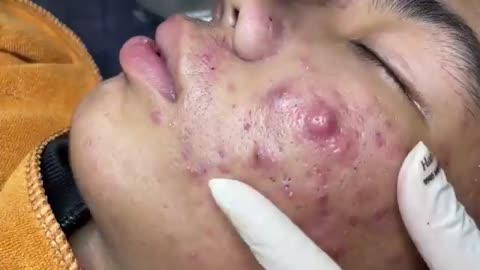Blackheads Pimple Whiteheads Removal